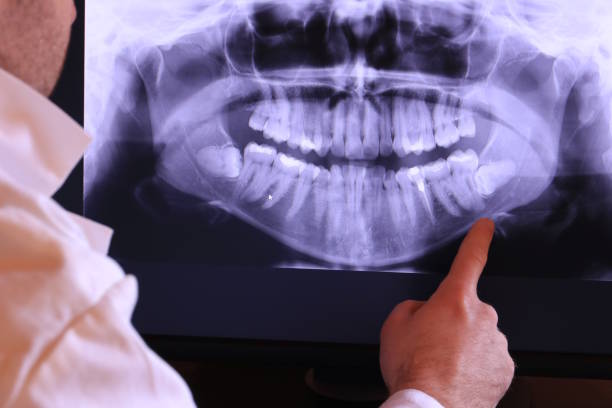 Best Emergency Wisdom Teeth Removal in Richland, GA
